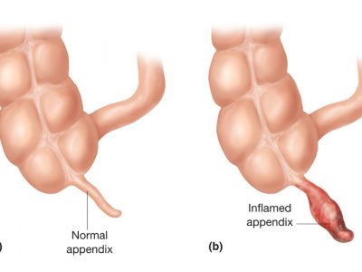 Blindtarmbetennelse (appendisitt)