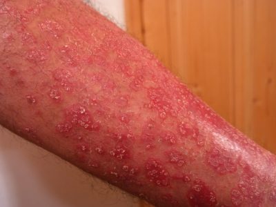 Immuntriggere ved autoimmun sykdom (5)