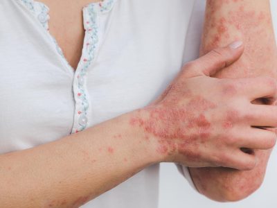Kan kosthold hjelpe mot psoriasis?